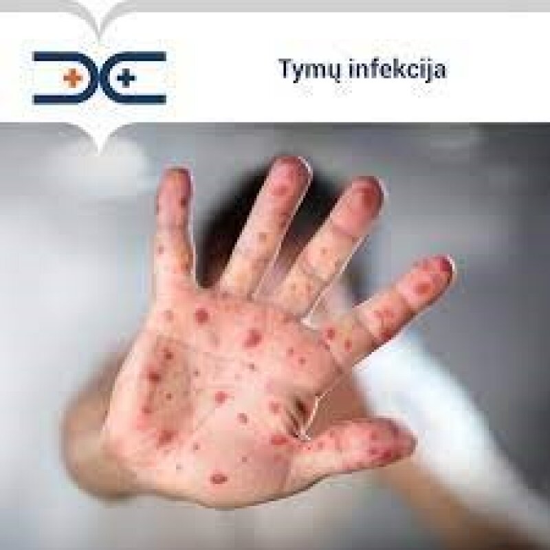 Nacionalinio visuomenės sveikatos centras informuoja apie tymų infekcinę ligą